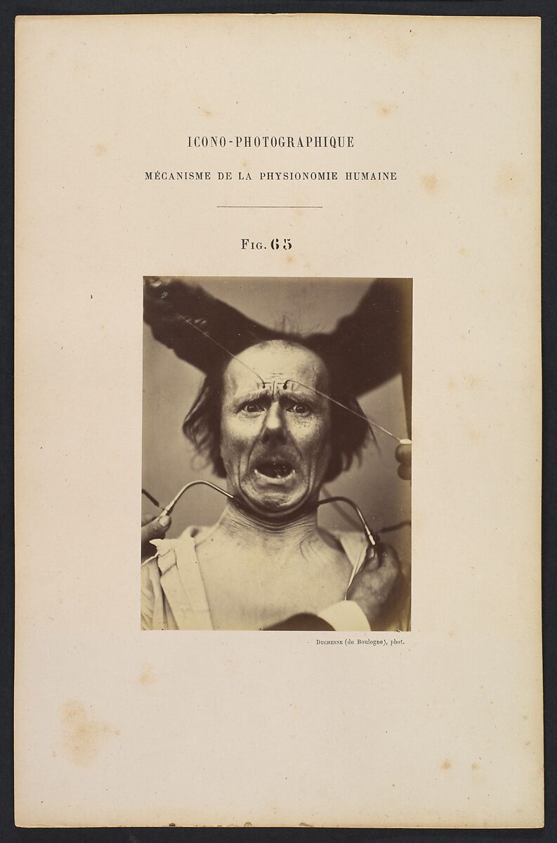 Icono-photographique. Mécanisme de la Physionomie Humaine. Fig. 65, Guillaume-Benjamin-Amand Duchenne de Boulogne (French, 1806–1875), Albumen silver print from glass negative