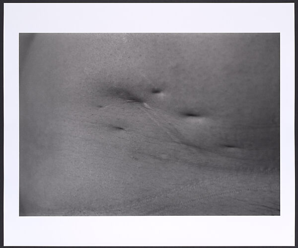 Scar #19, Illness-1964, Kyoto