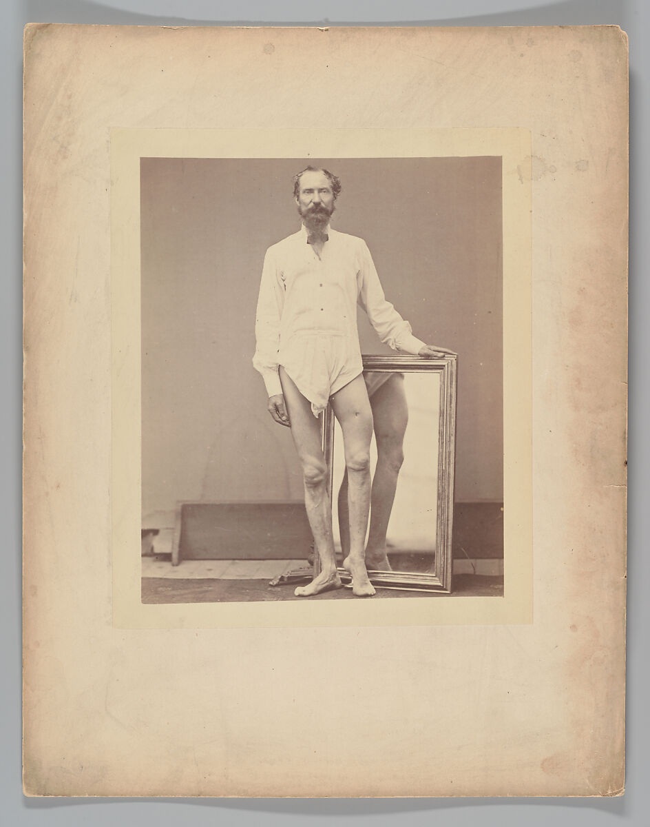 Gunshot Wound of Middle Third of Left Femur, William H. Bell (American (born England), Liverpool 1831–1910 Philadelphia, Pennsylvania), Albumen silver print from glass negative 