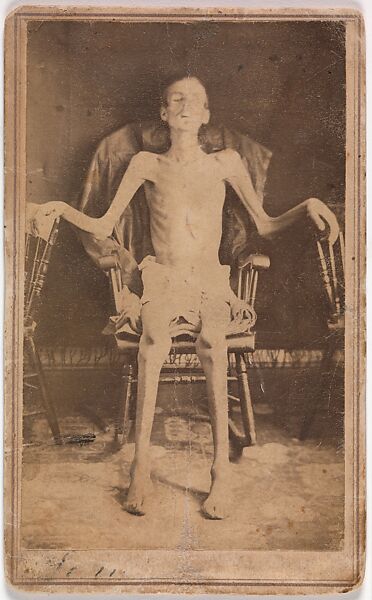 Emaciated Union Soldier Liberated from Andersonville Prison, J. W. Jones (American, active Orange, Massachusetts, 1860s), Albumen silver print from glass negative 