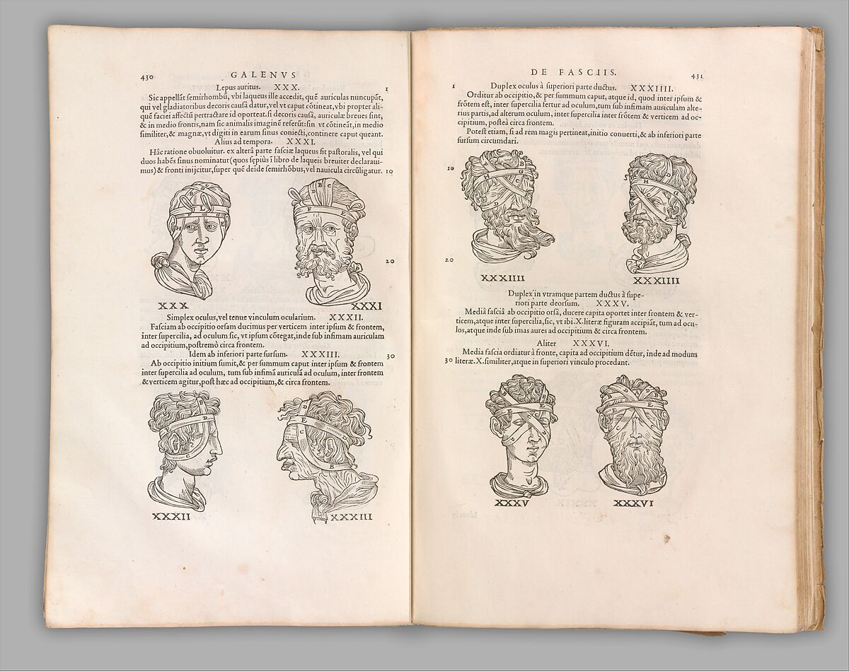 Chirurgia è Graeco in Latinum conversa, Vido Vidio Florentino interprete, Guido Guidi (Florence 1509–1569 Pisa), Printed book with 210 woodcut illustrations 