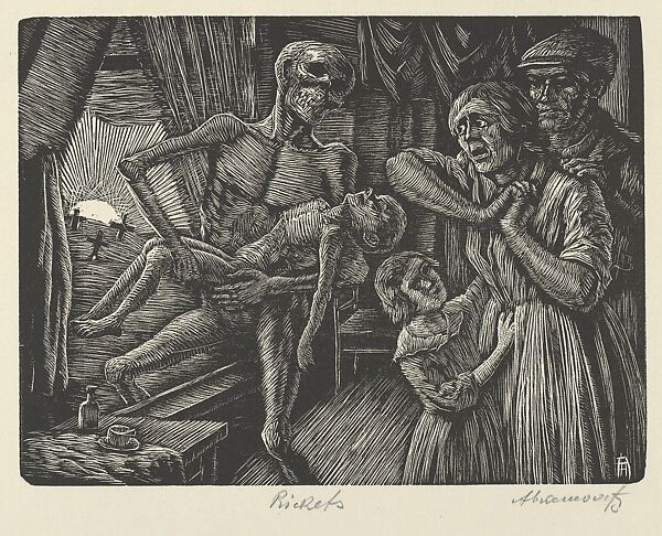Rickets, Albert Abramovitz (American, 1879–1963), Wood engraving