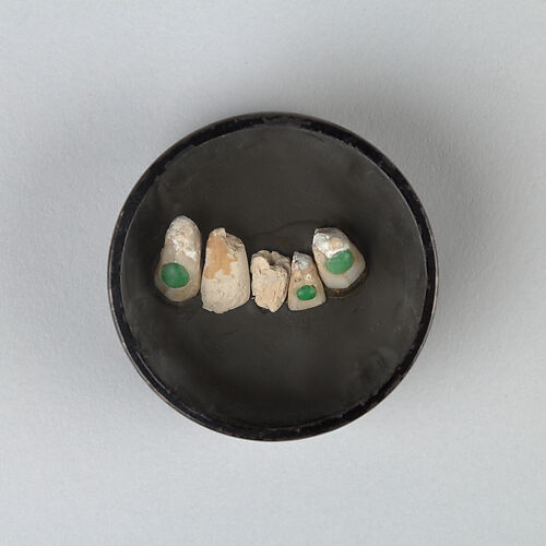 Human tooth inlaid with jadeite