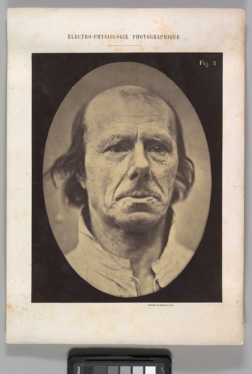 Figure 3: The face of an old man... photographed in repose., Guillaume-Benjamin-Amand Duchenne de Boulogne (French, 1806–1875), Albumen silver print from glass negative 