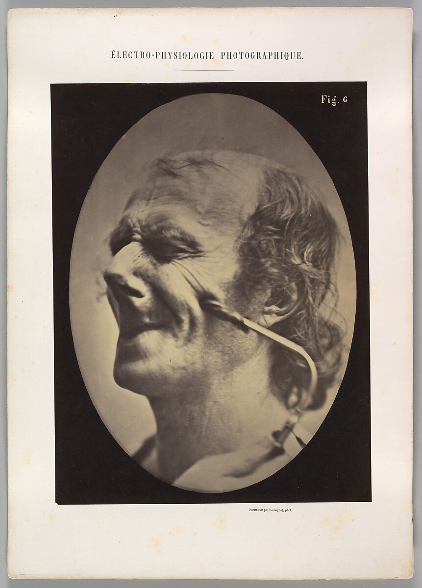 Figure 6: The grimice produced is similar to a tic of the face, Guillaume-Benjamin-Amand Duchenne de Boulogne (French, 1806–1875), Albumen silver print from glass negative 