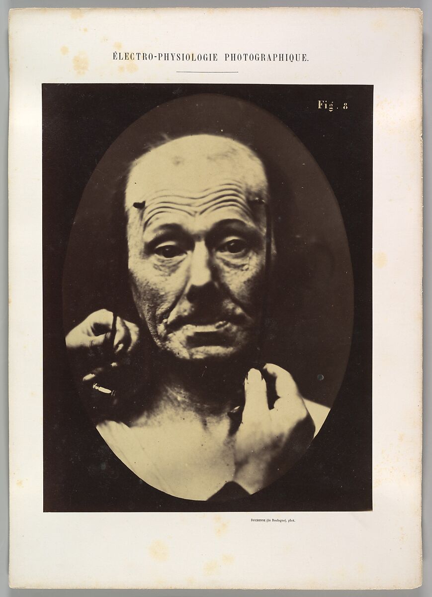 Figure 8: Contraction of the right m. frontalis., Guillaume-Benjamin-Amand Duchenne de Boulogne (French, 1806–1875), Albumen silver print from glass negative 