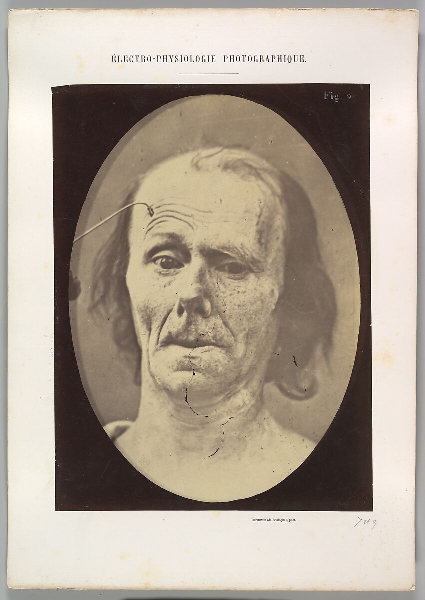 Figure 9: A study of m. frontalis in maximum contraction, Guillaume-Benjamin-Amand Duchenne de Boulogne (French, 1806–1875), Albumen silver print from glass negative 