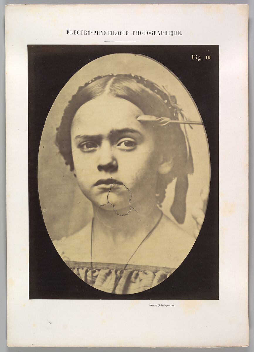 Figure 10: Showing the expressive lines of m. frontalis in a young girl, Guillaume-Benjamin-Amand Duchenne de Boulogne (French, 1806–1875), Albumen silver print from glass negative 