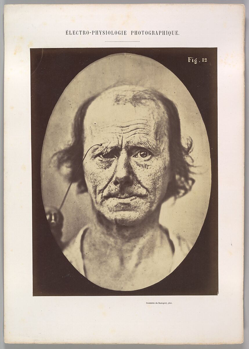 Figure 12: A study of the contraction of and the expression produced by the superior part of m. orbicularis oculi, Guillaume-Benjamin-Amand Duchenne de Boulogne (French, 1806–1875), Albumen silver print from glass negative 