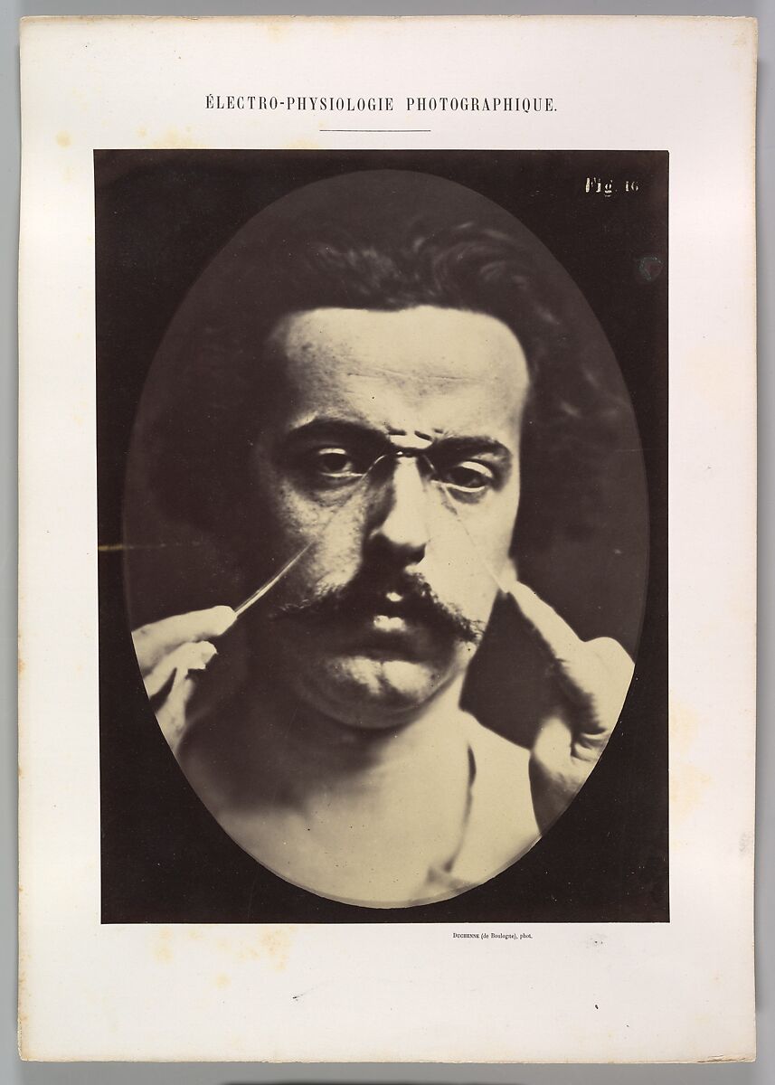 Figure 16: Expression of severity, Guillaume-Benjamin-Amand Duchenne de Boulogne (French, 1806–1875), Albumen silver print from glass negative 