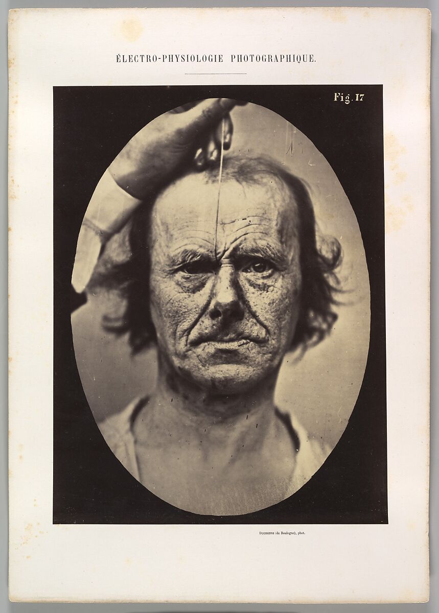 Figure 17: On the right, electrization of m. procerus: severity, aggression. On the left: attention., Guillaume-Benjamin-Amand Duchenne de Boulogne (French, 1806–1875), Albumen silver print from glass negative 