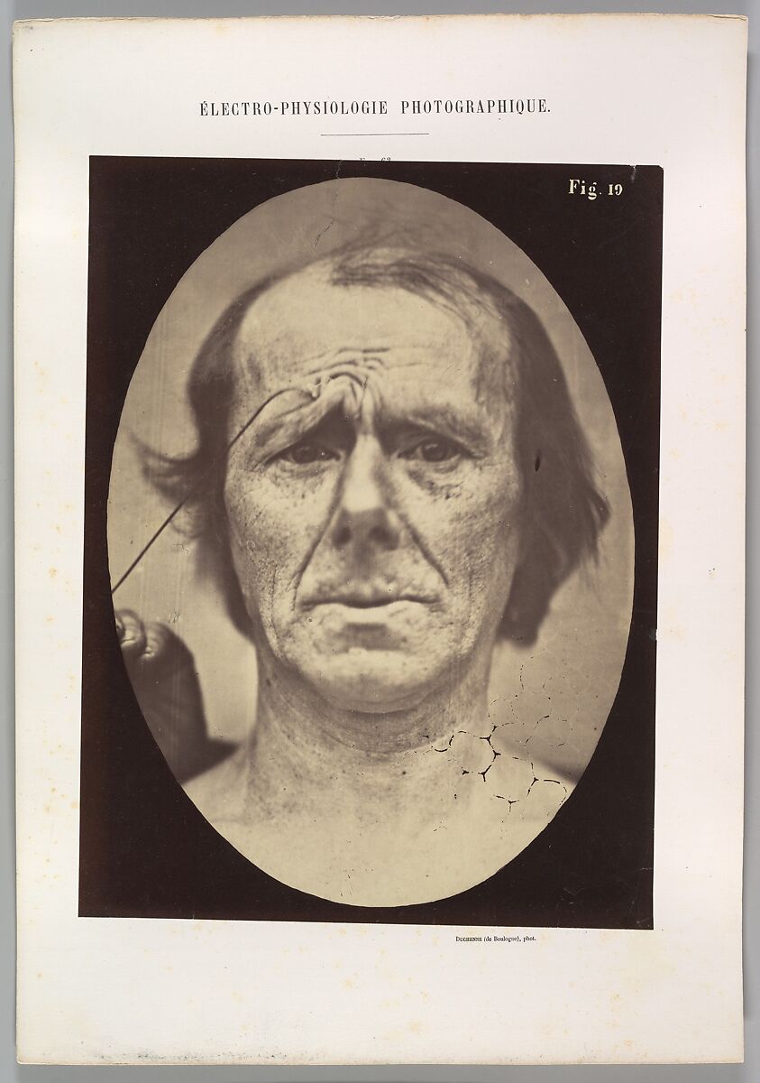 Figure 19: Suffering, Guillaume-Benjamin-Amand Duchenne de Boulogne (French, 1806–1875), Albumen silver print from glass negative 