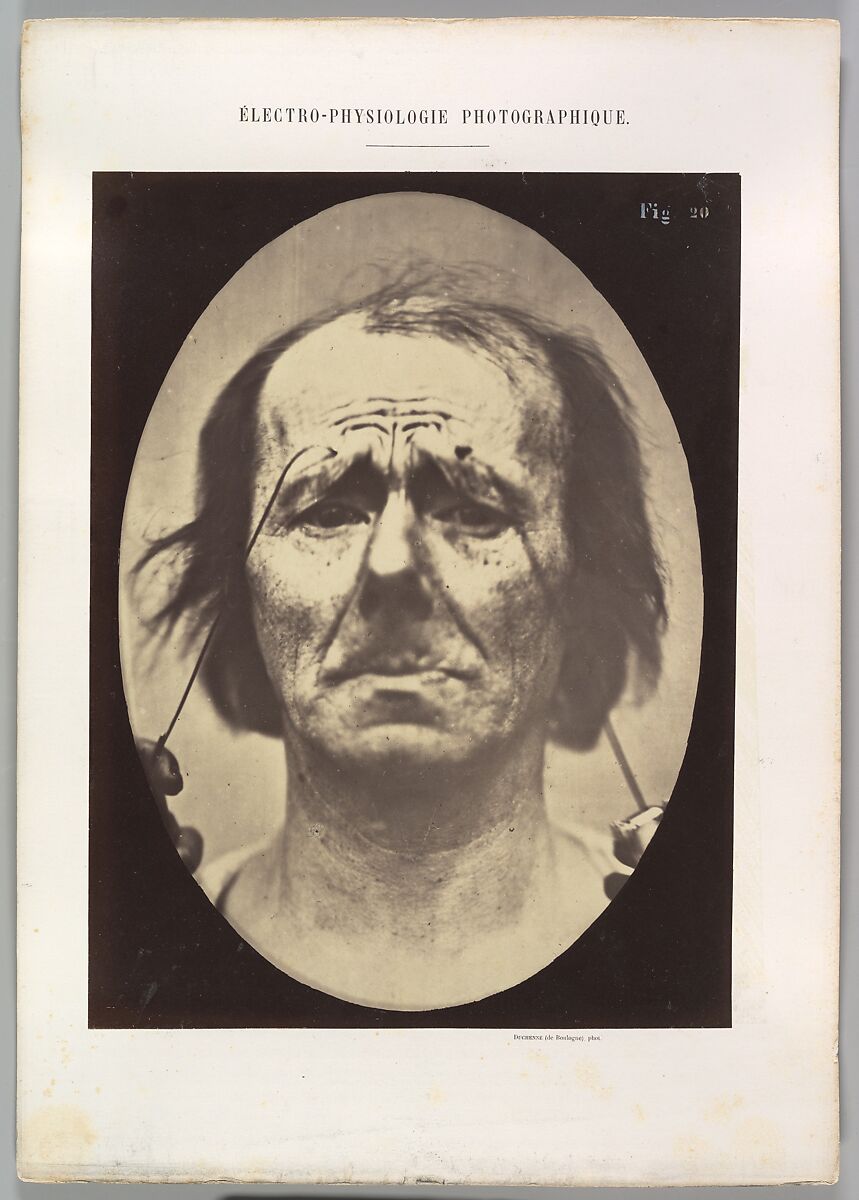 Figure 20: Profound suffering, with resignation, Guillaume-Benjamin-Amand Duchenne de Boulogne (French, 1806–1875), Albumen silver print from glass negative 
