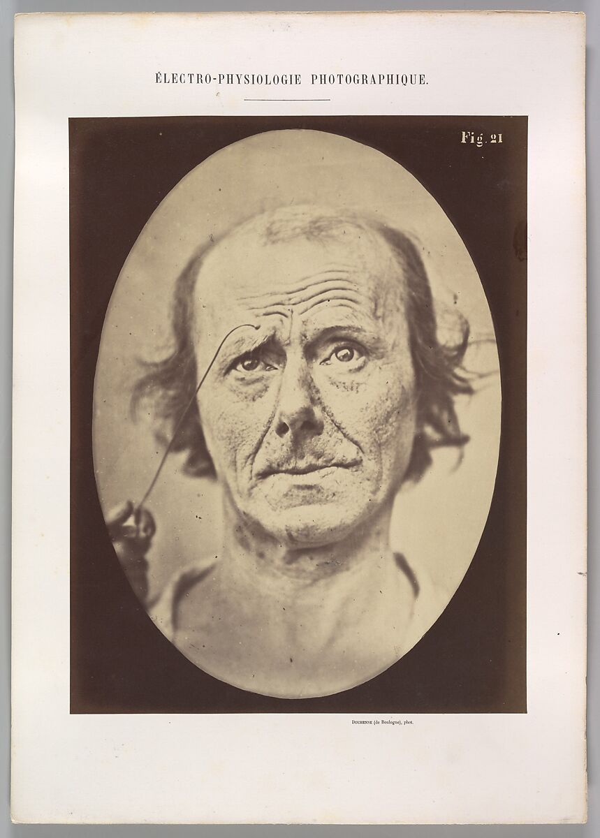 Figure 21: Painful recollection and recollection or calling something to mind, Guillaume-Benjamin-Amand Duchenne de Boulogne (French, 1806–1875), Albumen silver print from glass negative 