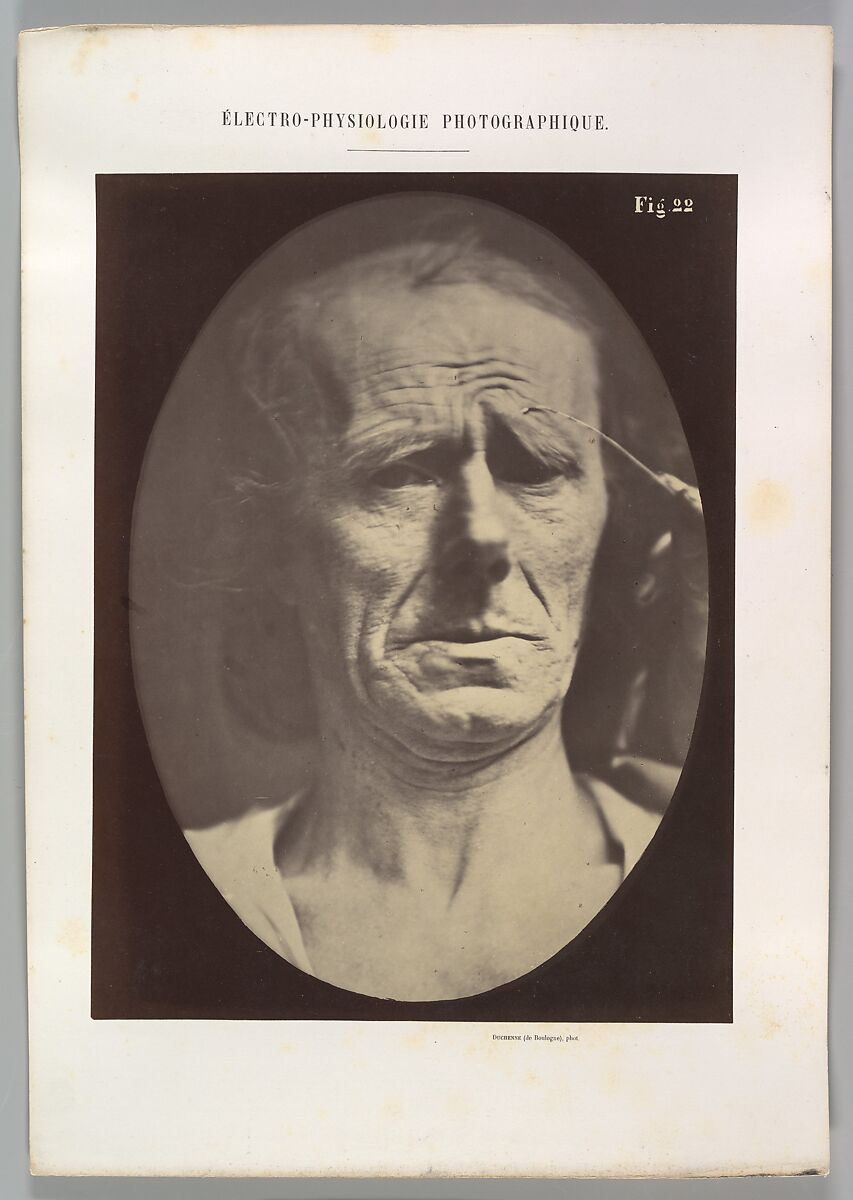 Figure 22: No painful expression, Guillaume-Benjamin-Amand Duchenne de Boulogne (French, 1806–1875), Albumen silver print from glass negative 