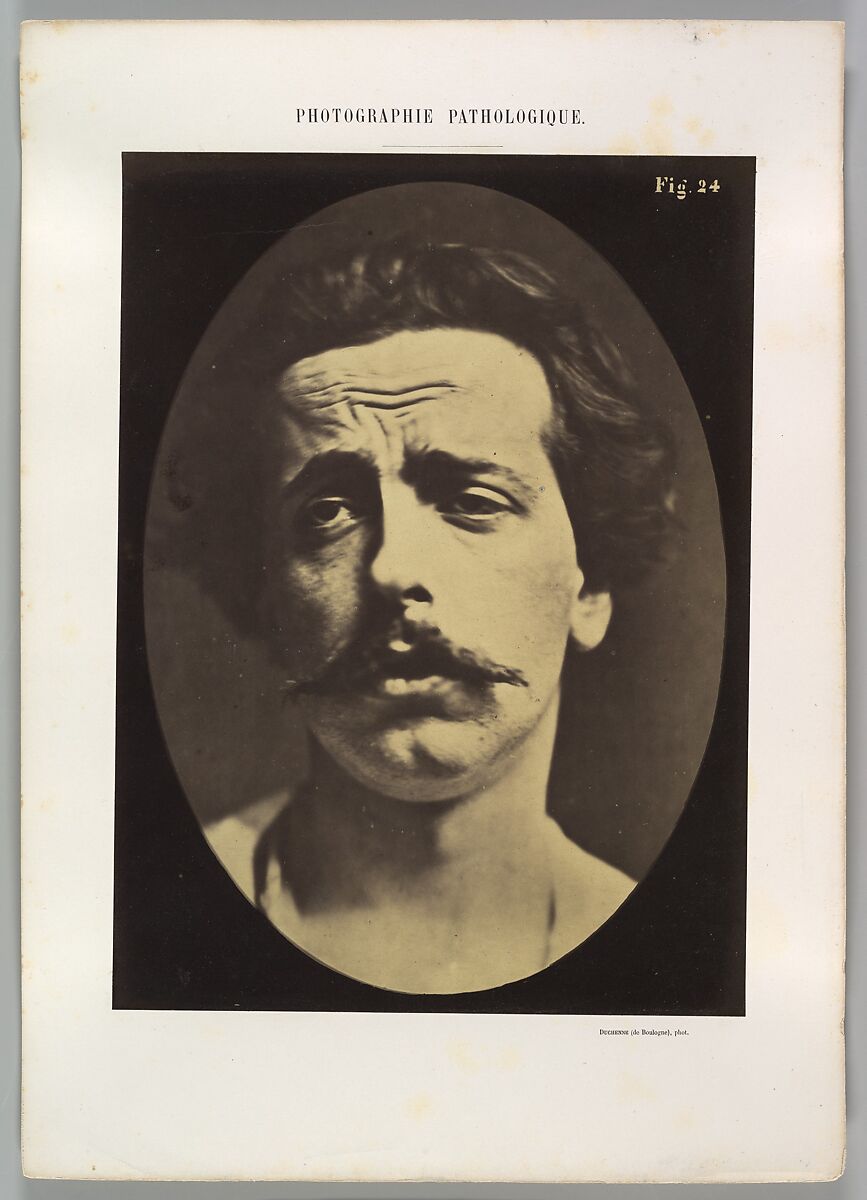 Figure 24: Extreme pain to the point of exhaustion, the head of Christ and memory of love or ecstatic gaze., Guillaume-Benjamin-Amand Duchenne de Boulogne (French, 1806–1875), Albumen silver print from glass negative 