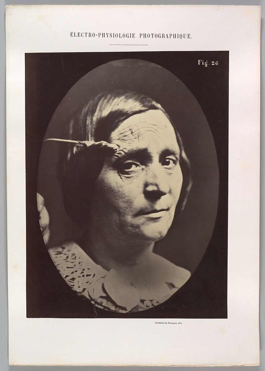 Figure 26: Expression of painful attention and attention, attentive gaze., Guillaume-Benjamin-Amand Duchenne de Boulogne (French, 1806–1875), Albumen silver print from glass negative 