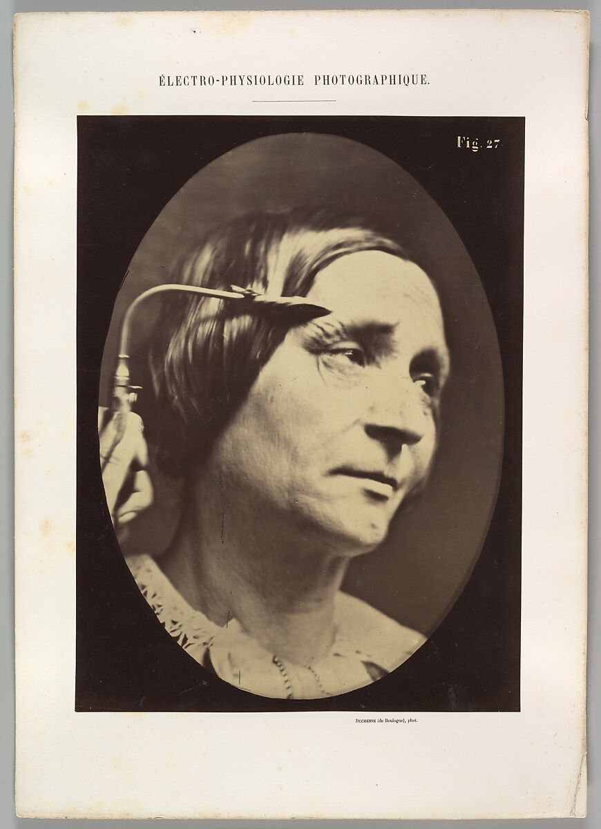 Figure 27: Expression proportionally more pained, Guillaume-Benjamin-Amand Duchenne de Boulogne (French, 1806–1875), Albumen silver print from glass negative 