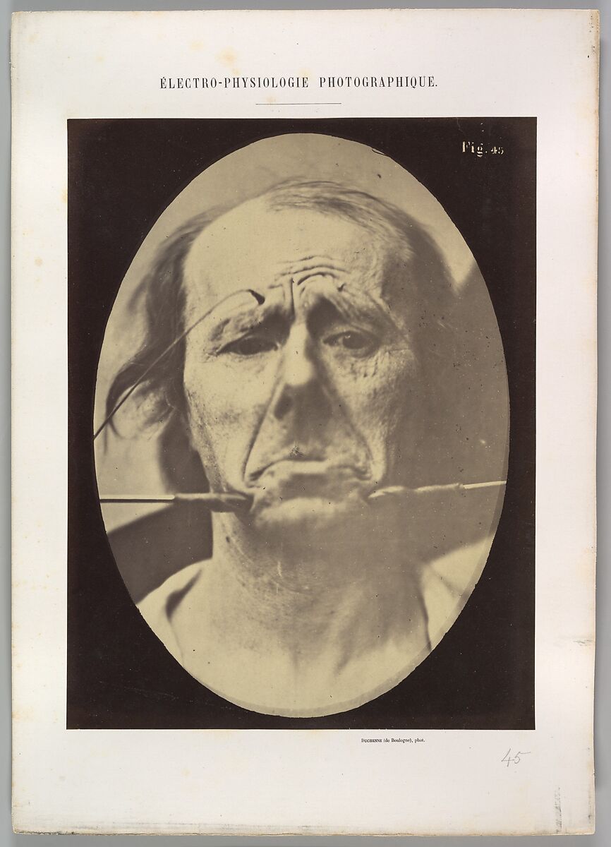 Figure 45: Pain and despair., Guillaume-Benjamin-Amand Duchenne de Boulogne (French, 1806–1875), Albumen silver print from glass negative 