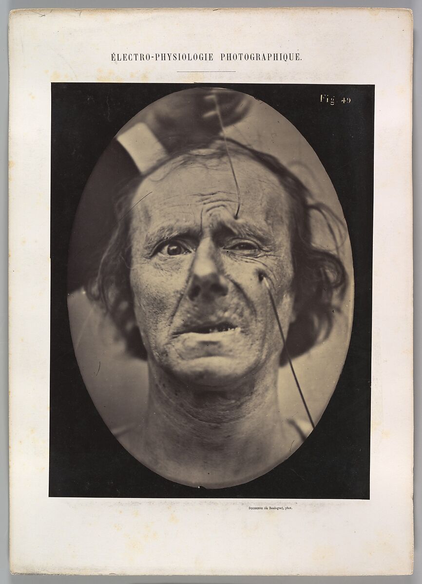 Figure 49: Painful weeping and forward looking., Guillaume-Benjamin-Amand Duchenne de Boulogne (French, 1806–1875), Albumen silver print from glass negative 