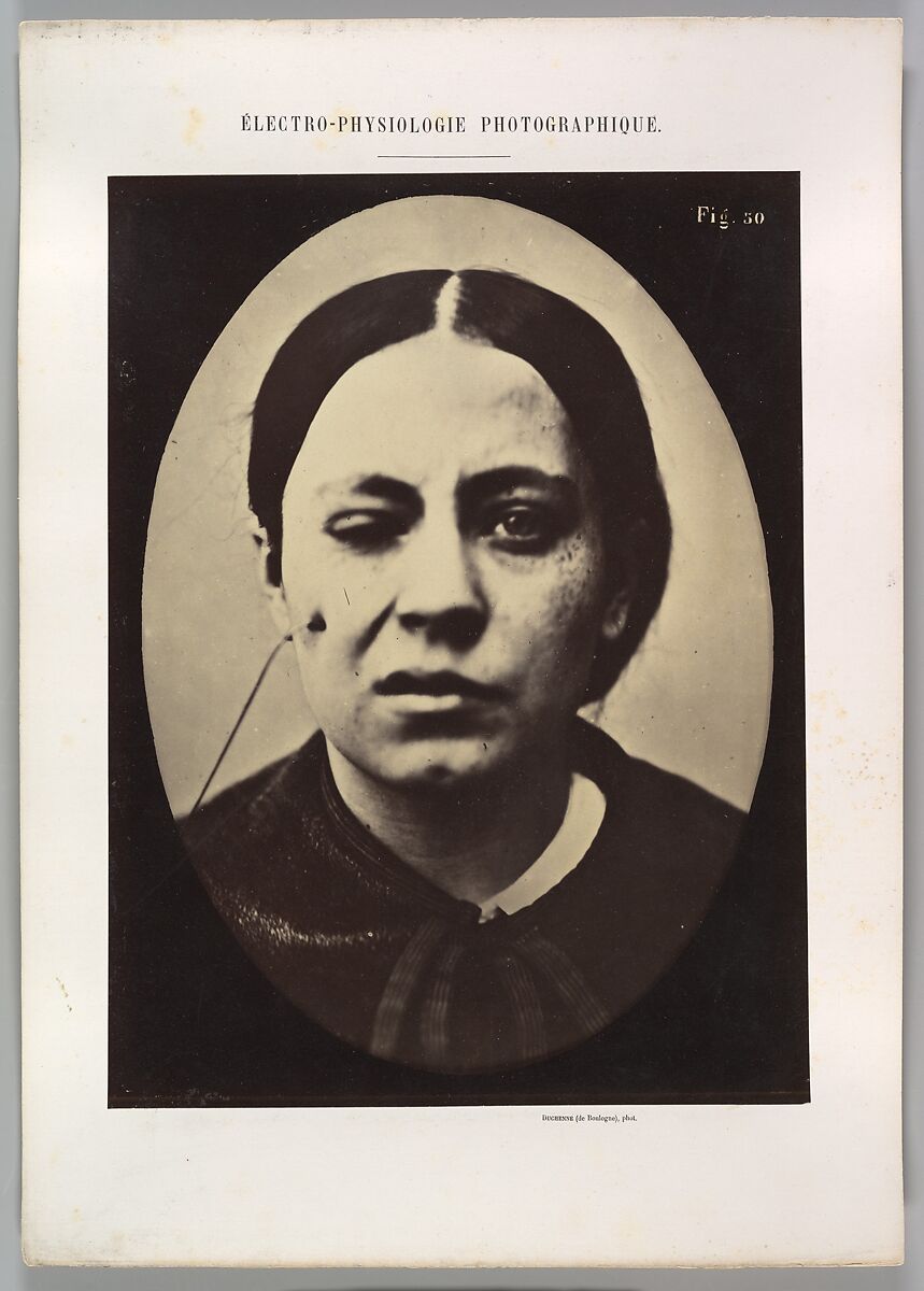 Figure 50: Affected weeping and face in repose, Guillaume-Benjamin-Amand Duchenne de Boulogne (French, 1806–1875), Albumen silver print from glass negative 