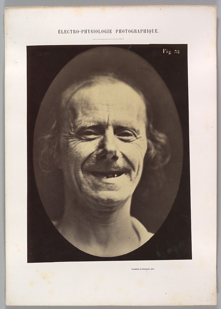 Figure 52: Voluntary retraction of the lower lip, Guillaume-Benjamin-Amand Duchenne de Boulogne (French, 1806–1875), Albumen silver print from glass negative 