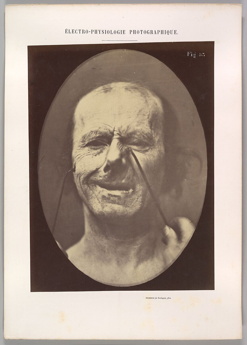 Figure 53: Whimpering and false laughter, Guillaume-Benjamin-Amand Duchenne de Boulogne (French, 1806–1875), Albumen silver print from glass negative 