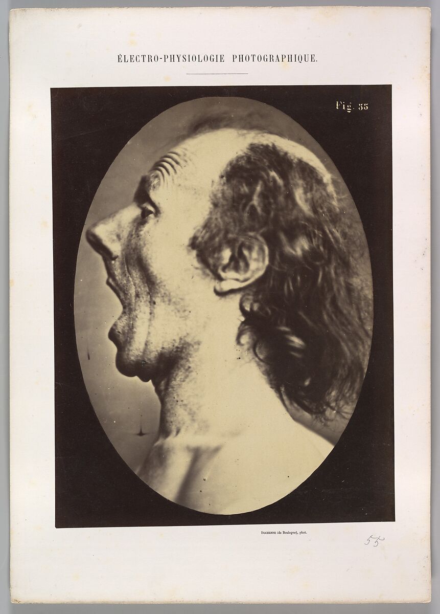 Figure 55: Astonishment badly rendered by the subject: a ridiculous and inane expression., Guillaume-Benjamin-Amand Duchenne de Boulogne (French, 1806–1875), Albumen silver print from glass negative 
