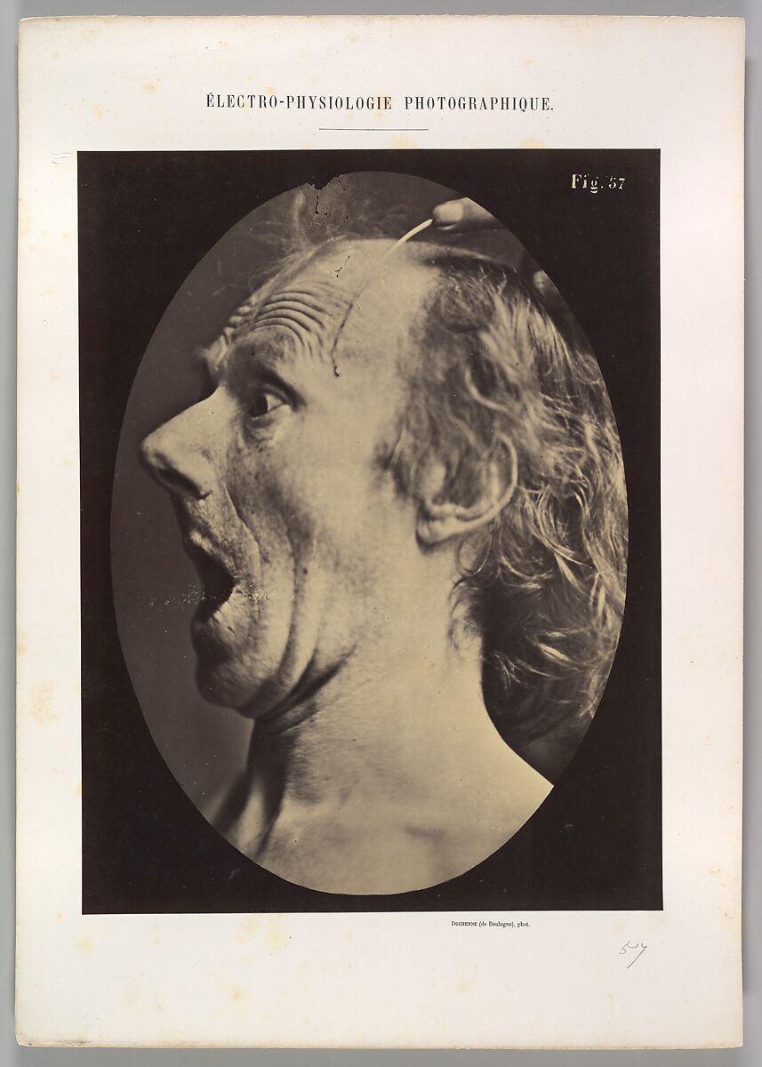 Figure 57: Astonishment, stupefaction, amazement, Guillaume-Benjamin-Amand Duchenne de Boulogne (French, 1806–1875), Albumen silver print from glass negative 