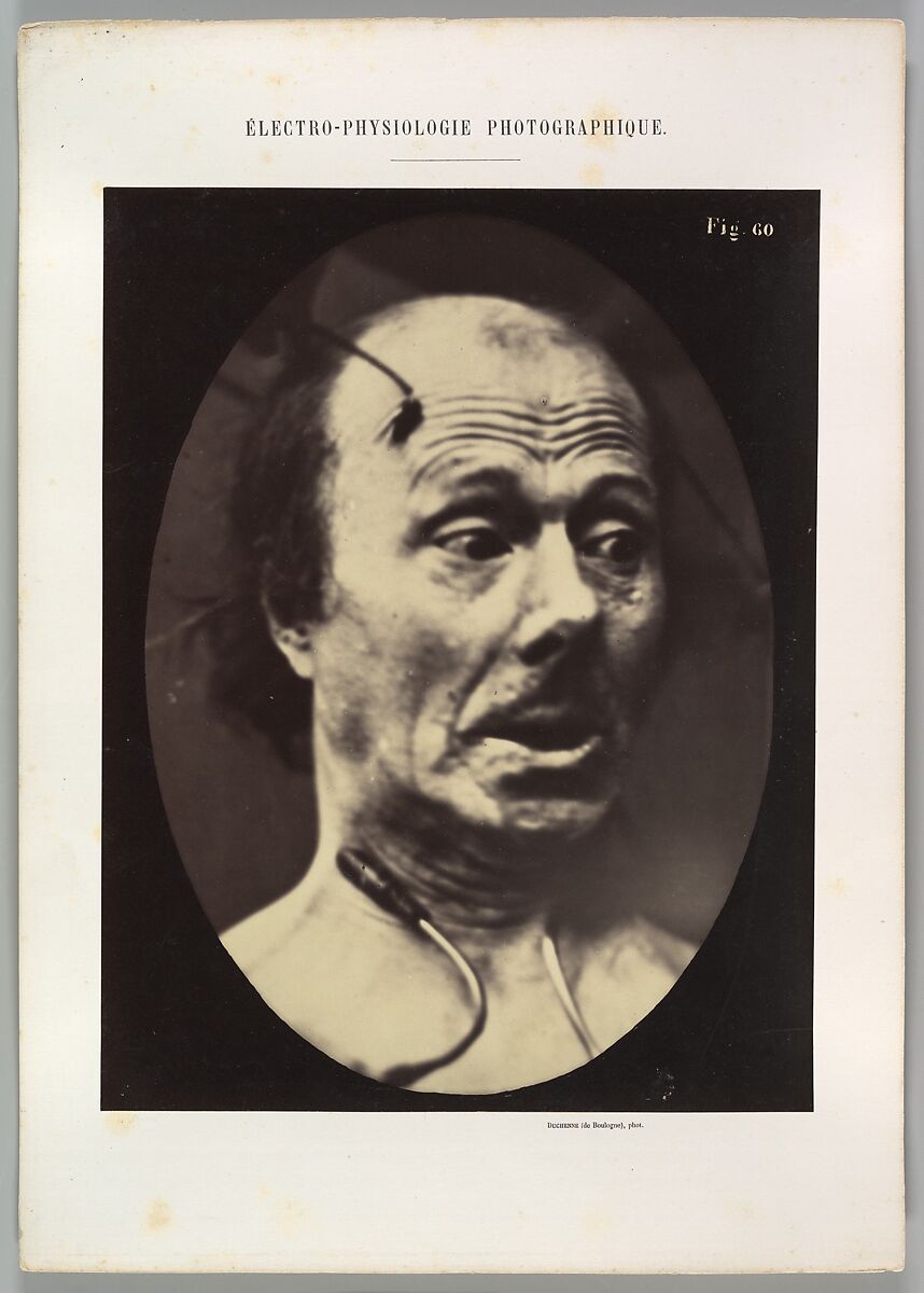 Figure 60: Fright, Guillaume-Benjamin-Amand Duchenne de Boulogne (French, 1806–1875), Albumen silver print from glass negative 