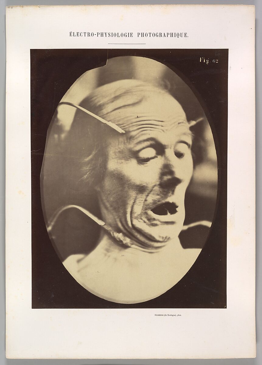 Figure 62: Terror, semiprofile, Guillaume-Benjamin-Amand Duchenne de Boulogne (French, 1806–1875), Albumen silver print from glass negative 