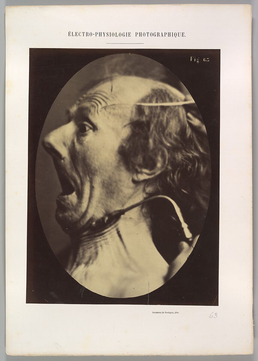 Figure 63: Expression of terror, Guillaume-Benjamin-Amand Duchenne de Boulogne (French, 1806–1875), Albumen silver print from glass negative 