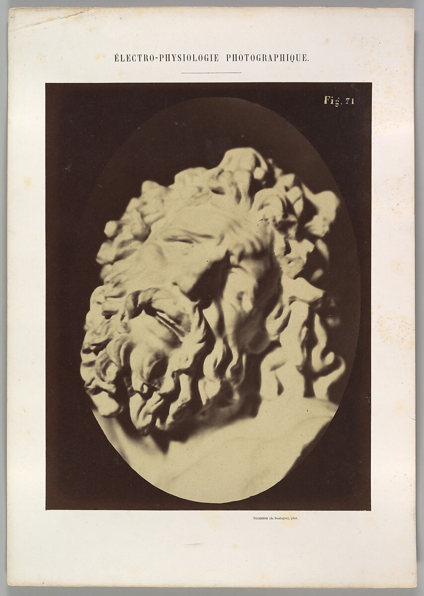 Figure 71: Same head as in Plate 70, Guillaume-Benjamin-Amand Duchenne de Boulogne (French, 1806–1875), Albumen silver print from glass negative 
