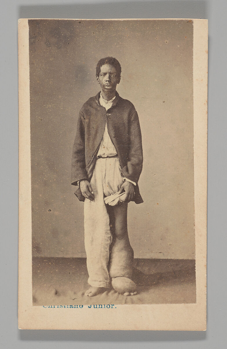 [Studio Portrait: Man Standing with Swollen Leg and Foot Caused by Elephantiasis, Brazil], Christiano Junior (Portuguese, active Argentina, 1832–1902), Albumen silver print 