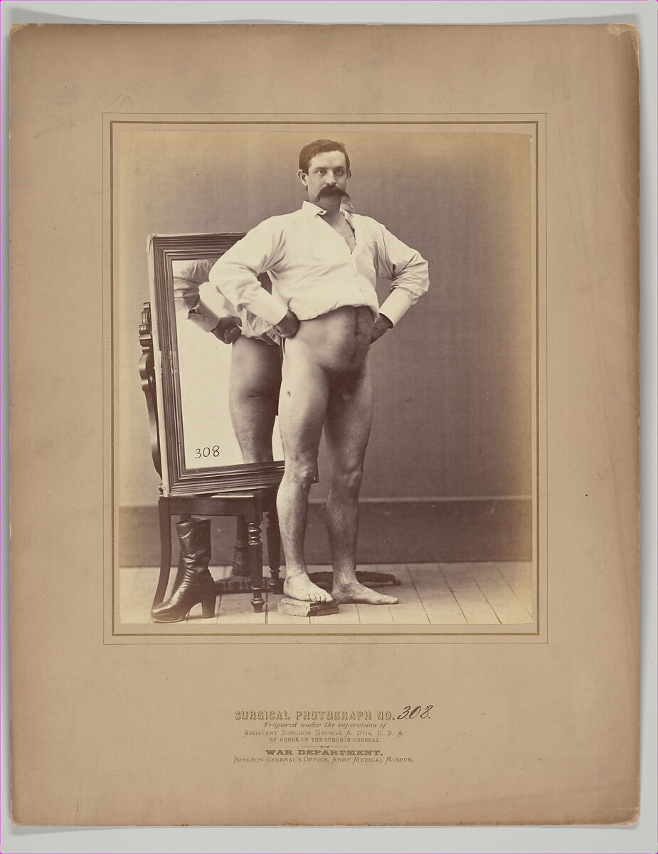 A Compound Comminuted Fracture of the Femur Successfully Treated with Smith's Anterior Splint, Possibly William H. Bell (American (born England), Liverpool 1831–1910 Philadelphia, Pennsylvania), Albumen silver print from glass negative 
