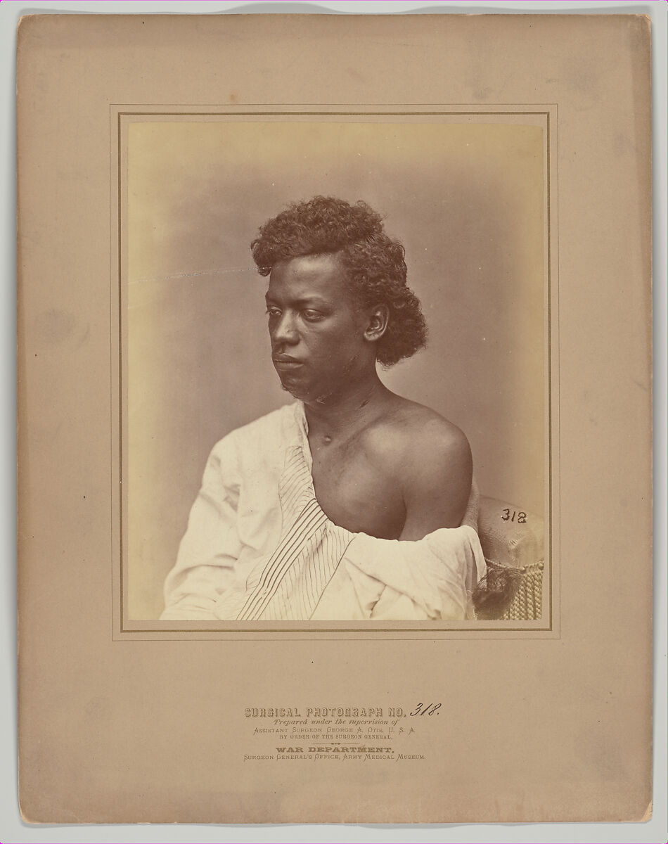 Fistulous Openings in the Jaw and Neck, William H. Bell (American (born England), Liverpool 1831–1910 Philadelphia, Pennsylvania), Albumen silver print from glass negative 
