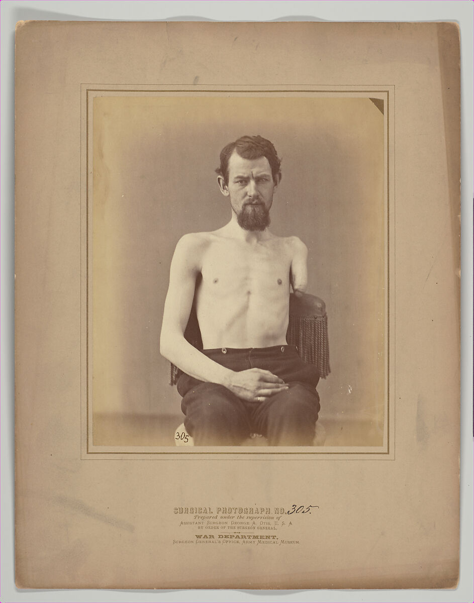 Amputation of the Left Arm for Gunshot Injury, E. J. Ward (American, active 1860s), Albumen silver print from glass negative 